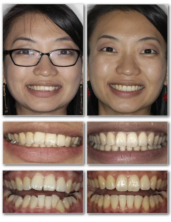 Invisalign Angled Smile Example 1