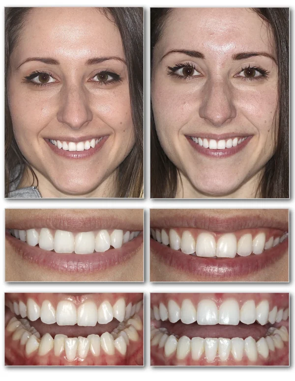 Invisalign Crowded Lower Example 1