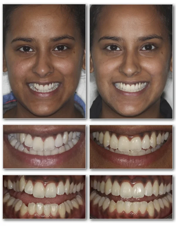 Invisalign Narrow Smile Example 1