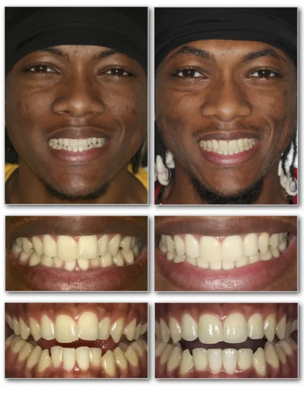 Invisalign Crowding Teeth Before and After