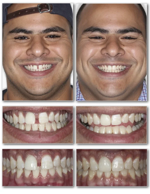 Invisalign Spaced Teeth Before and After